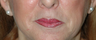 Lip Augmentation with Lip Lift for Natural, Refreshed Look