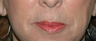 Lip Augmentation with Lip Lift for Natural, Refreshed Look