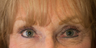 Endoscopic brow lift