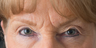Endoscopic brow lift