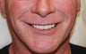 40 year old male treated with All-on-4 Dental Implant Procedure