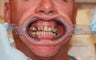 40 year old male treated with All-on-4 Dental Implant Procedure