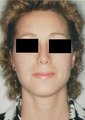Revision Rhinoplasty