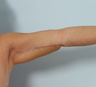 Arm Lift