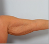 Arm Lift