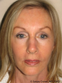 Facelift