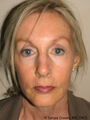 Facelift