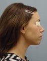 Chin Augments