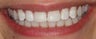 Bleaching and Fillings to Correct White Spots on Teeth