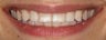Bleaching and Fillings to Correct White Spots on Teeth