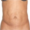 Smart Lipo with Tummy Tuck
