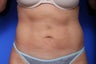 Coolsculpting Before and After