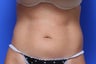 Coolsculpting Before and After