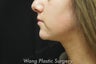 Chin Augmentation with Radiesse filler