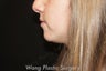 Chin Augmentation with Radiesse filler