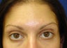 Forehead Lines