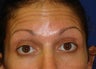 Forehead Lines