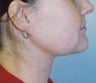 Young patient undergoes liposuction to treat excess neck and jowl fat