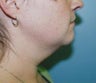 Young patient undergoes liposuction to treat excess neck and jowl fat