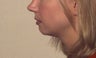 Chin implant