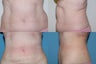 Smartlipo love handles
