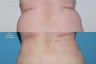 Smartlipo love handles