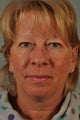 Upper Eyelid Surgery