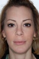 Chin Implant