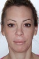 Chin Implant