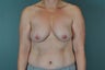 Breast Lift