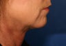 49 Year Old Chin Augmentation