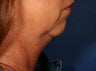 49 Year Old Chin Augmentation