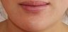 Lip Implant