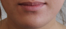 Lip Implant