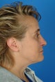 Revision septorhinoplasty