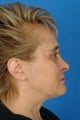 Revision septorhinoplasty
