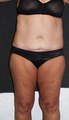 Liposuction & Abdominoplasty