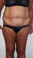 Liposuction & Abdominoplasty