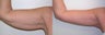 Body Contouring: Arm Lift