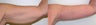 Body Contouring: Arm Lift