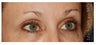 Eye Area Rejuvenation
