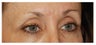 Eye Area Rejuvenation