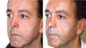 Revision Rhinoplasty Corrects Over-Resection, Tip Asymmetry