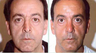Revision Rhinoplasty Corrects Over-Resection, Tip Asymmetry