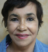 Mini Face Lift and Brow Lift
