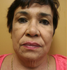 Mini Face Lift and Brow Lift