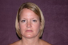 Neck Liposuction
