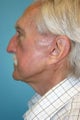 75 Year Old male Interested in Facial Rejuvenation