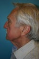 75 Year Old male Interested in Facial Rejuvenation