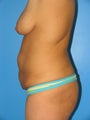 28 year old woman for body lift